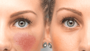 Mujer con rosacea mejor crema hidratante