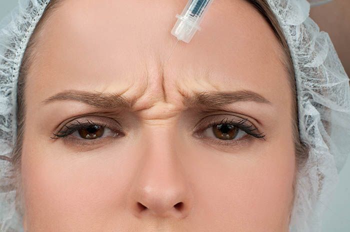 Infiltracion botox frente
