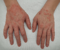 dermatitis atópica del adulto