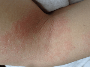 Eccema atópico pliegues