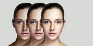 Pecas, manchas faciales