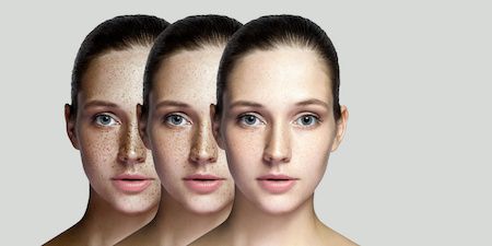 Pecas, manchas faciales
