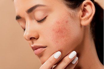 Crema antimanchas rosacea