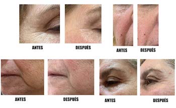 radiofrecuencia facial en casa resultados