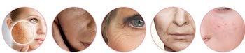 Radiofrecuencia facial antes y después
