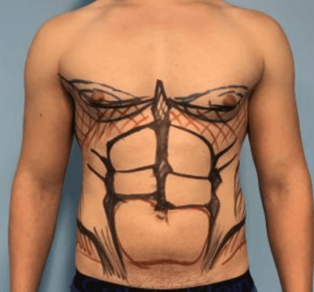Vaser Lipo