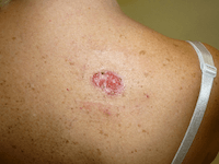 Tipos de cáncer de piel