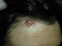 Tipos cáncer de piel