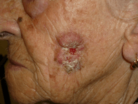 Cáncer de piel epidermoide