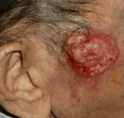 Tipos cáncer de piel