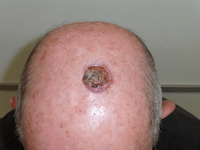 Cáncer de piel epidermoide