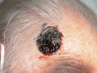 Cáncer de piel melanoma