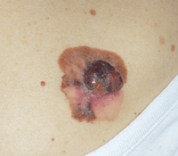 Cáncer de piel melanoma