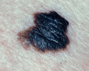 Cáncer de piel melanoma