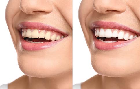 Blanqueamiento dental